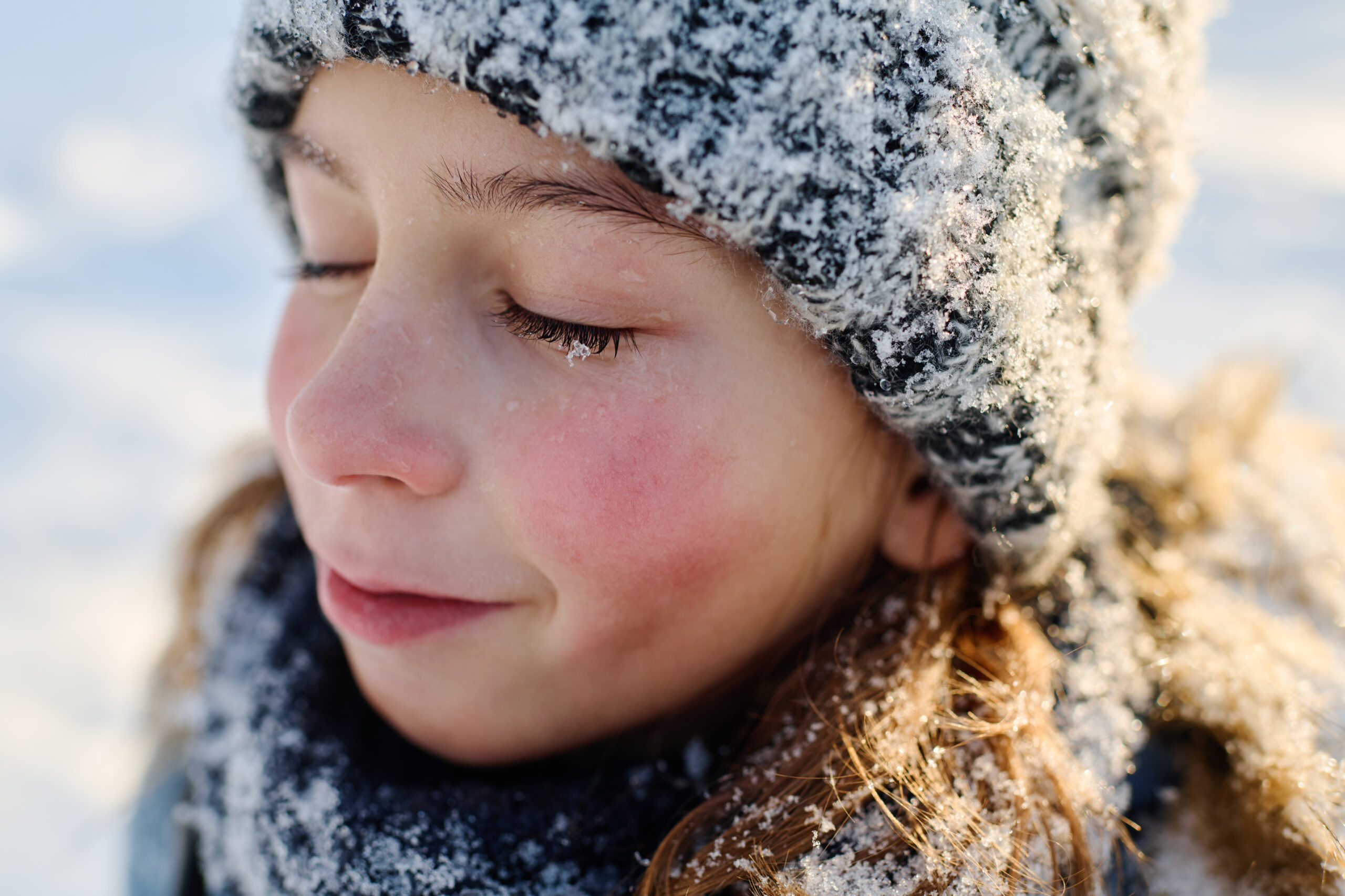 Queimadura causada pelo frio: confira os sintomas e como se proteger